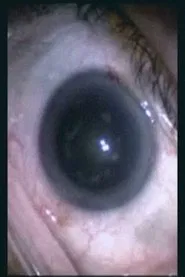 Botched Eyeball Operation movie poster
